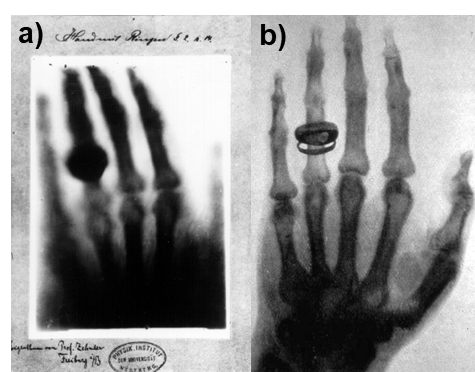 Early X-ray radiographs showing the bones of the hand.